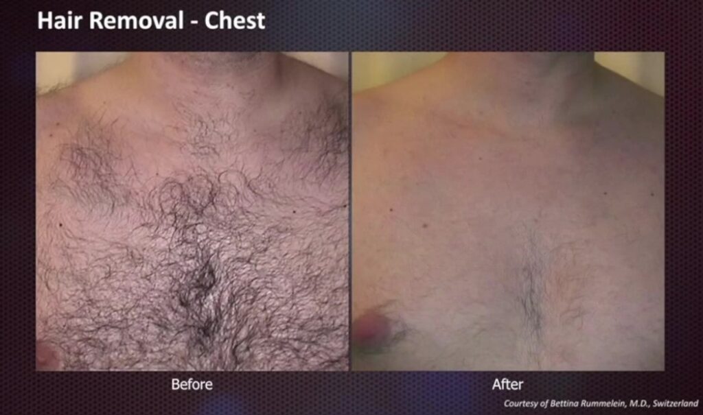 chest man before after laser depilation at dr ghali aesthetic center medicine