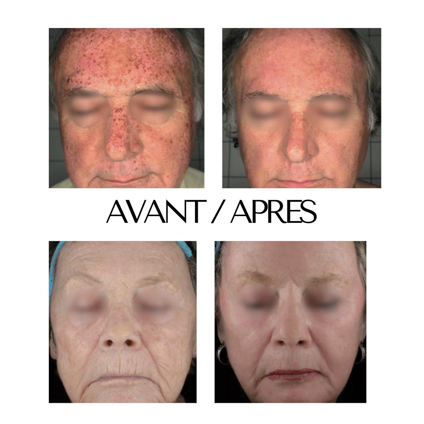 homme et femme matures avant et après un laser co2 du visage