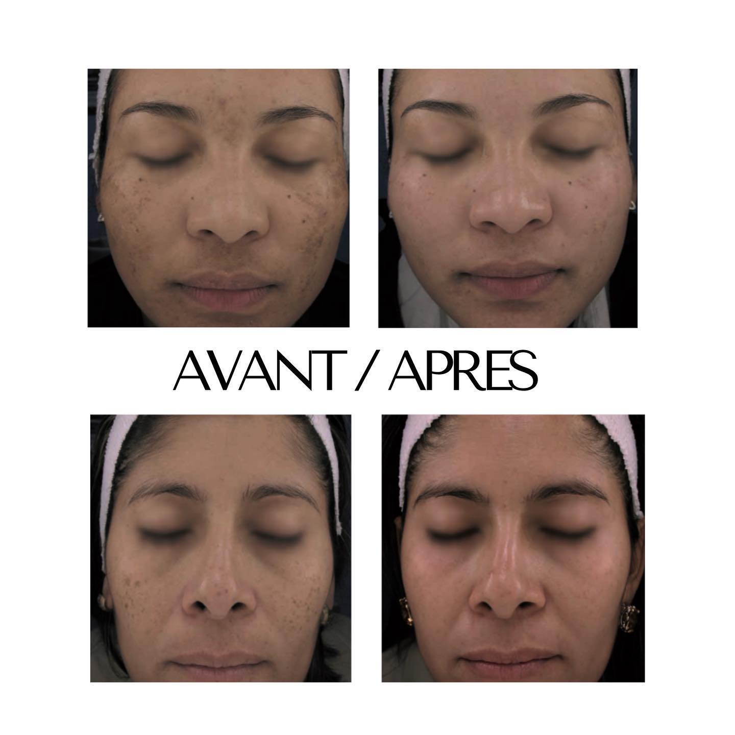 jeune femme avant et après un traitement laser des taches du visage en laser co2