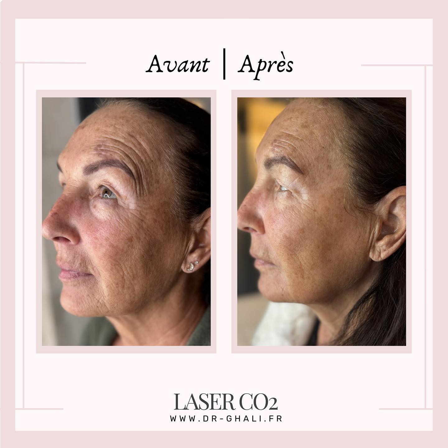 femme de 60 ans avant et après un laser co2 du visage