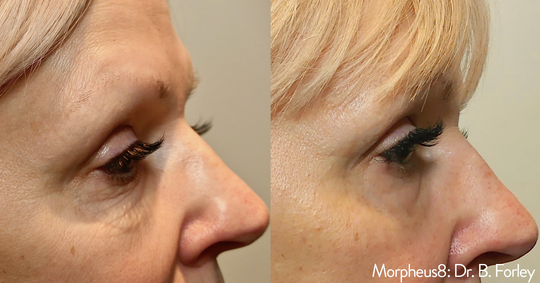 before after morpheus treatment for a woman