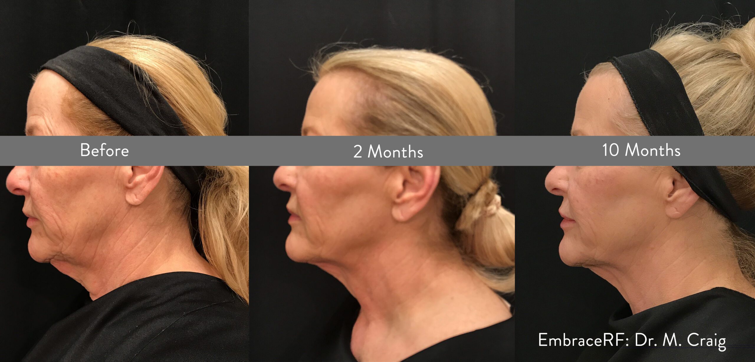 before after morpheus face and neck treatment for a woman