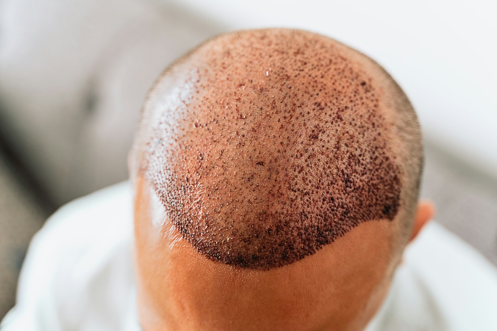 After hair transplantation surgical technique that moves hair follicles. Young bald man with hair