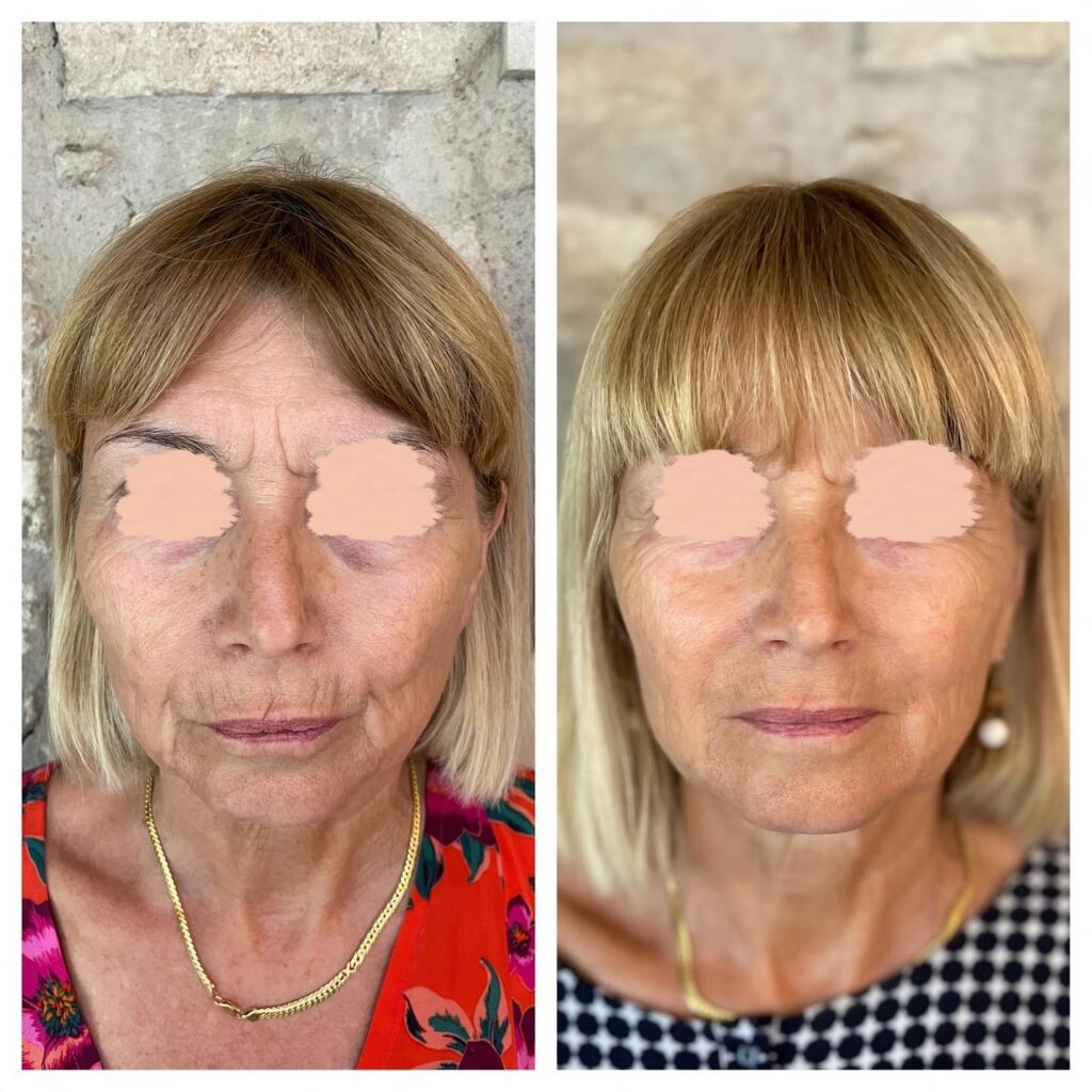 hyaluronic acid injection in face to glow up for mature woman by dr ghali copyright