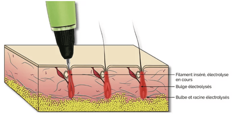 EXPLICATION ELECTROLYSE