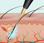 EXPLICATION DE ELECTROLYSE