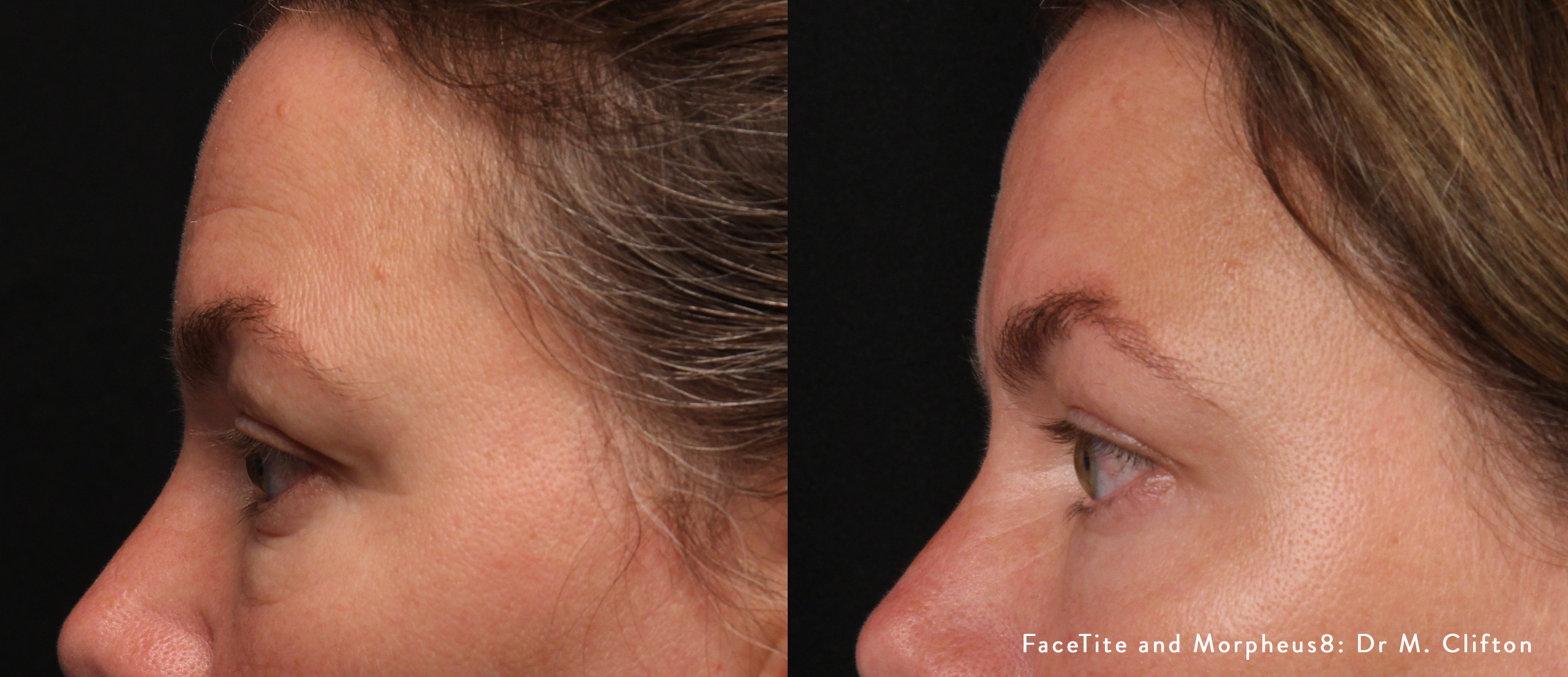 FaceTite and Morpheus8 Before & After (2)