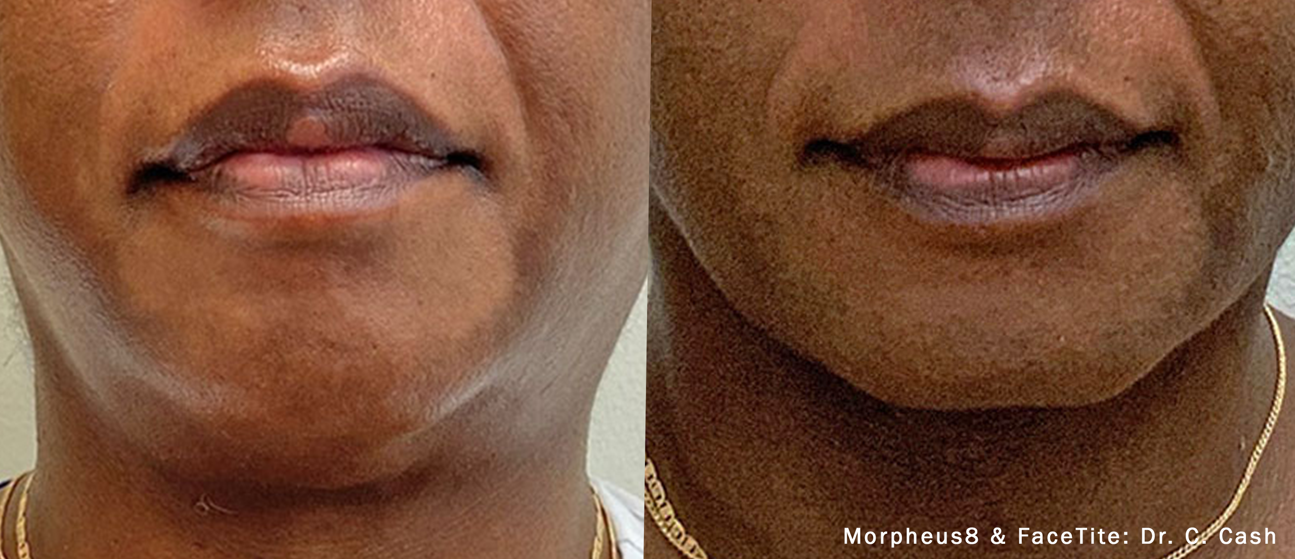 Morpheus8 & FaceTite Before and After