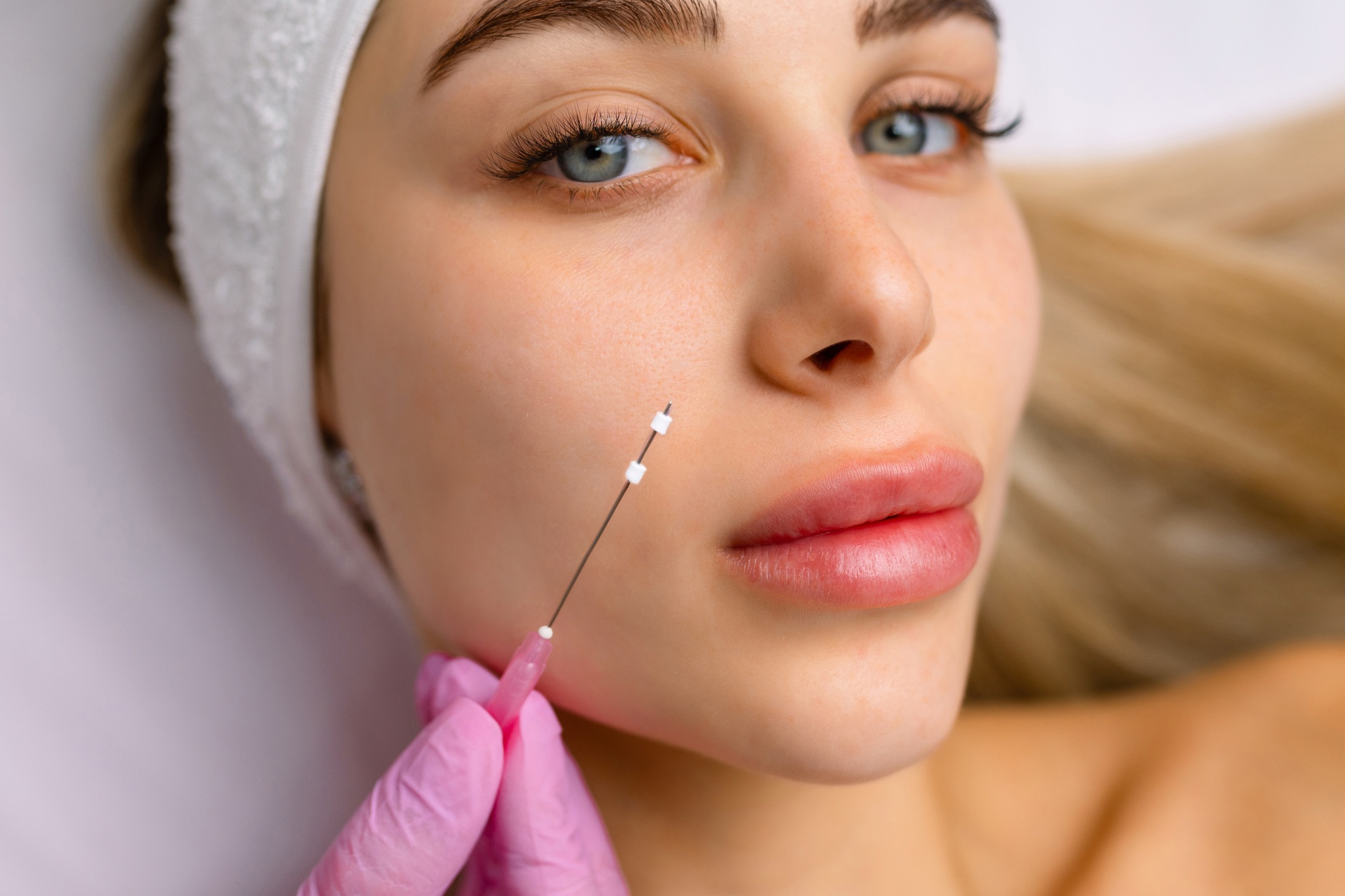Face lifting PDO threads suture operation. innovative technique of New thread lift, cosmetologist preparing