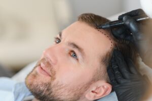 Doctor marking young man's forehead with hair loss problem