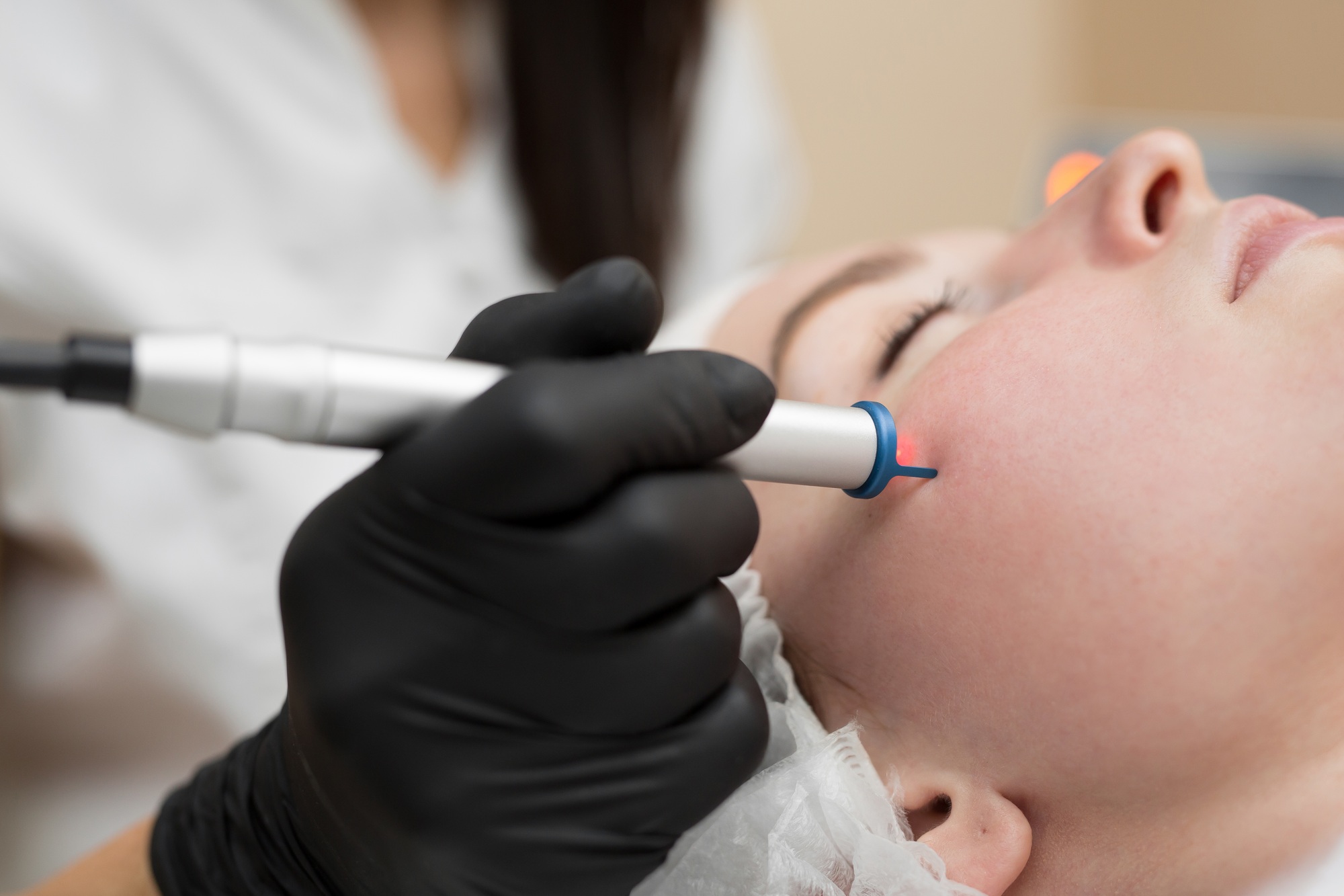 Close-up removal of blood vessels on the face of a diode laser in a cosmetic clinic.