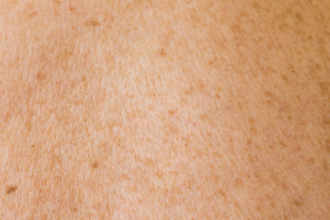 Photo laser hair removal