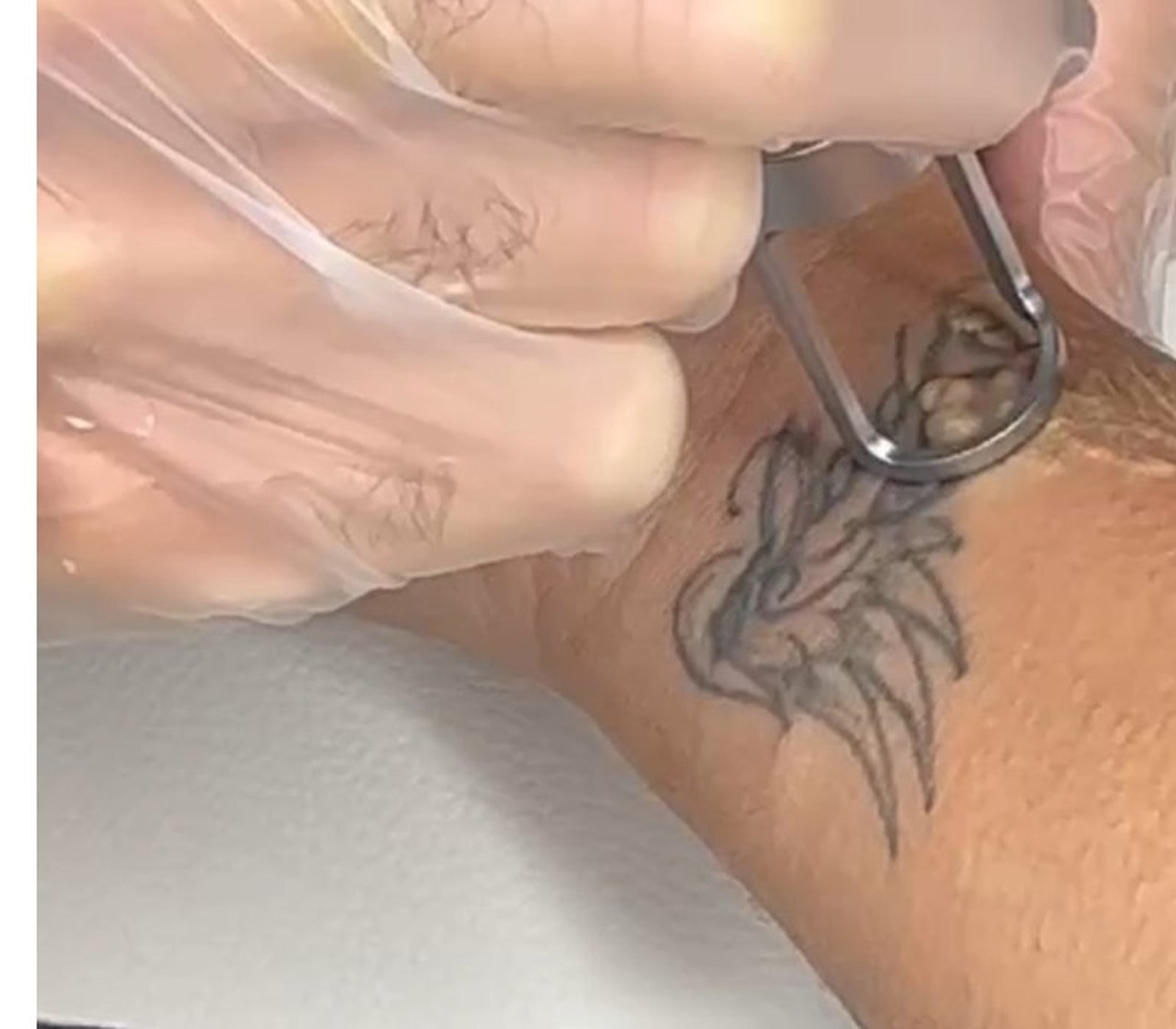 Tatouage à effacer