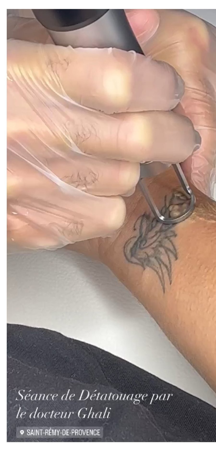 Détatouage laser