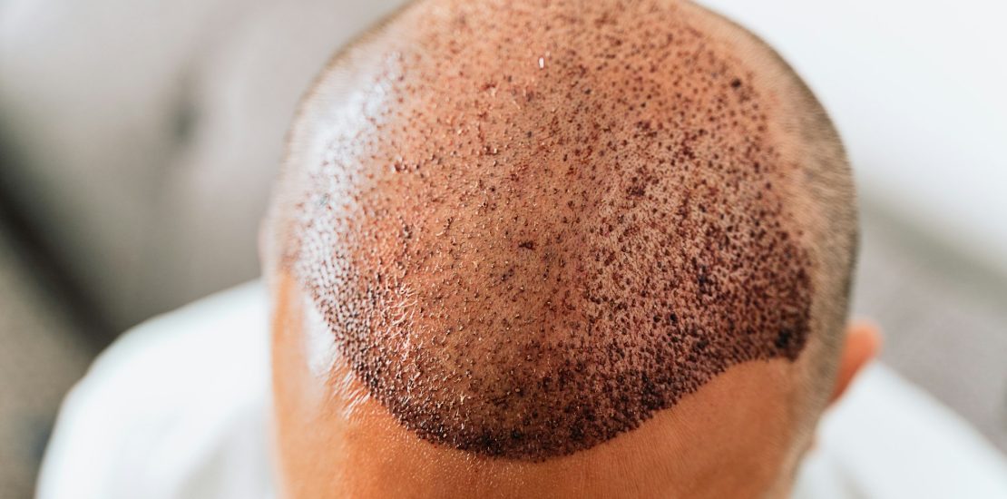 After hair transplantation surgical technique that moves hair follicles. Young bald man with hair