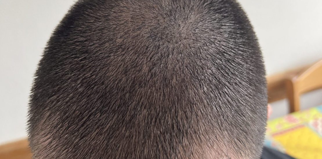 croutes du cuir chevelu après une greffe de cheveux