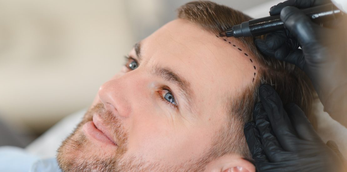 Doctor marking young man's forehead with hair loss problem