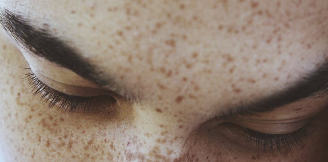 woman with freckles after laser depilation
